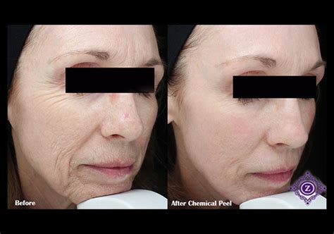 Chemical Peels Dermatologist In Baton Rouge La Z Aesthetic