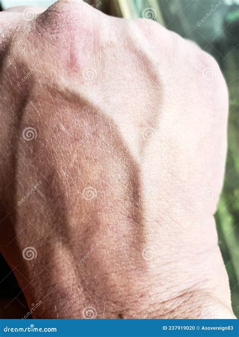 Visible Vein On The Hand Stock Photo Image Of Dermatology 237919020