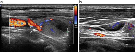 Normal Thyroid Appearance And Anatomic Landmarks In Neck Ultrasound