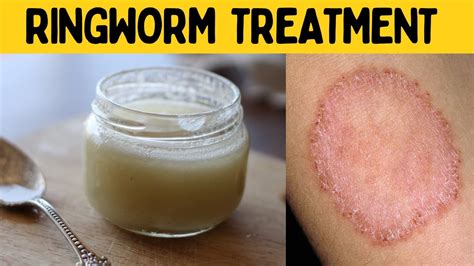 How To Get Rid Of Ringworm Permanently Fast At Home 3 Day Ringworm