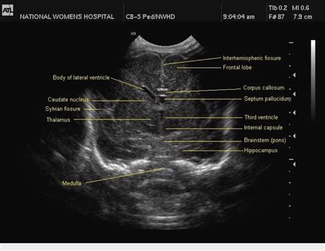 Infant Head Ultrasound Anatomy Dbabyzi