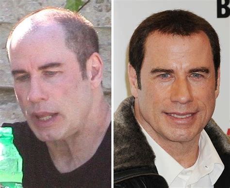 John Travolta Plastic Surgery Botox And Hair Transplant