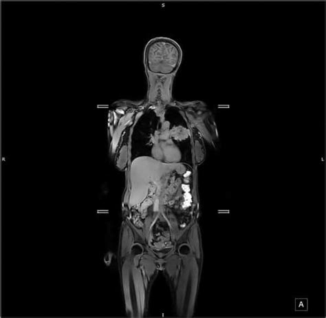 Whole Body Mri More Efficient Than Multiple Scans At Assessing Spread