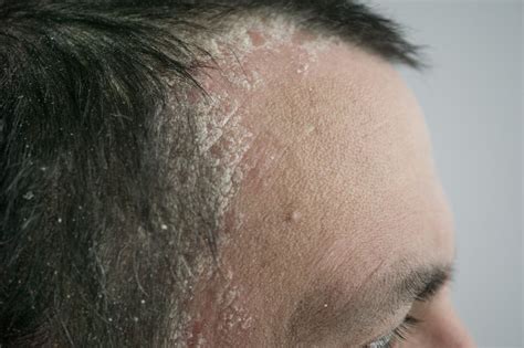 Psoriasis Der Kopfhaut Was Dermatologen Wünschen Dass Sie Wüssten