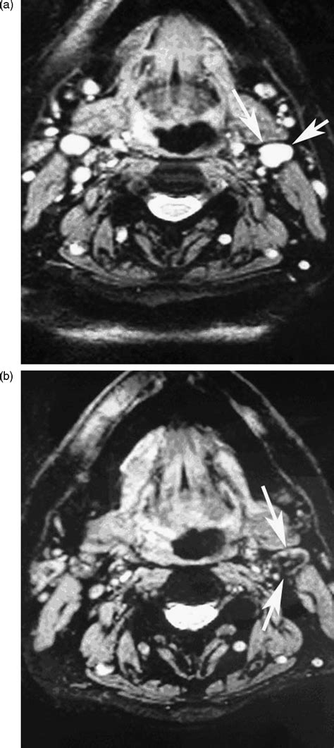 Cervical Lymph Nodes European Journal Of Radiology