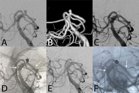 Frontiers Neuroform Atlas Stent Assisted Coiling Of Tiny Wide Necked