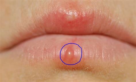 Small Pus Filled Bumps Pictures Photos