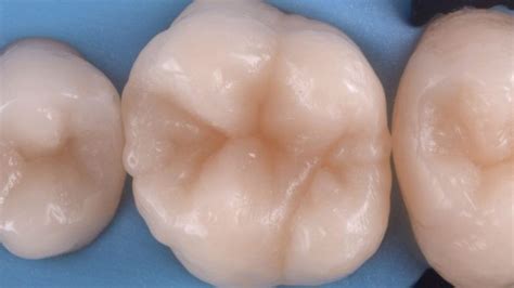 Step By Step Protocol Restoring The First Upper Molar