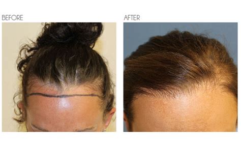 Female Hair Loss Specialist Los Angeles Resolve Abouthairloss