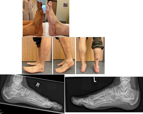 Personalized Approach For Complex Bilateral Calcaneal Osteomyelitis And