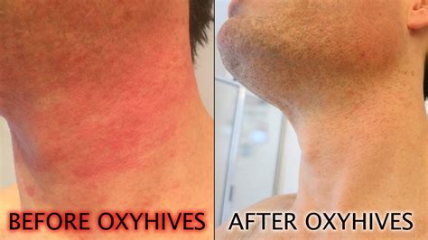 How To Get Rid Of Hives With The Oxyhives Hives Treatment Youtube