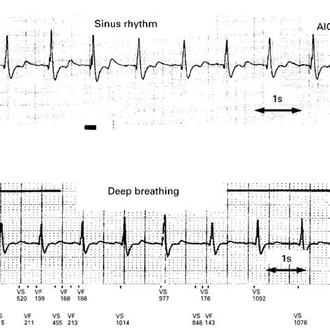 Recording Of Real Time Ecg Top And Ecg During Deep Breathing Bottom