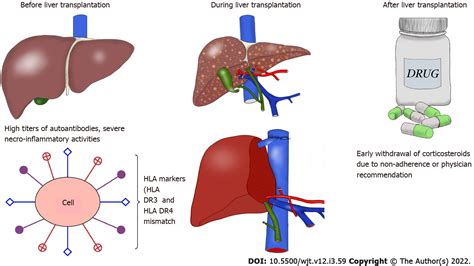 Autoimmune Hepatitis And Liver Transplantation Indications And