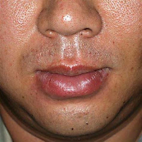 Macrocheilia Of The Lower Lip Tongue And Hypertrophy Of Lingual