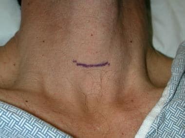 Minimally Invasive Surgery Of The Thyroid Treatment Management