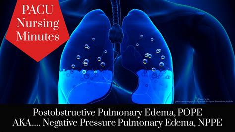 Postobstructive Pulmonary Edema POPE AKA Negative Pressure