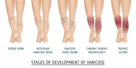 Varicose Veins During Pregnancy Causes Tips To Help You Cope