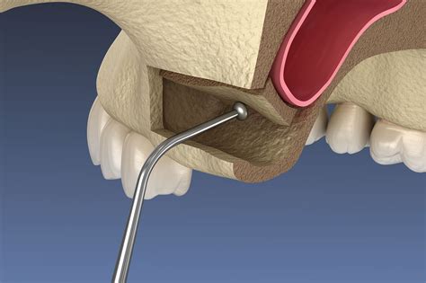 Sinus Lift Sinus Augmentation Sparacino Periodontics