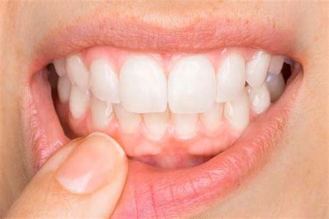Why Healthy Gums Are Vital To Oral Health Acadia Dental Clinic