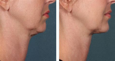 Belkyra Lakeshore Vein And Aesthetics Clinic Pre And Post Images