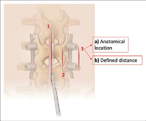 Incision Locations For Retractor Insertion 1 Midline 2 Close