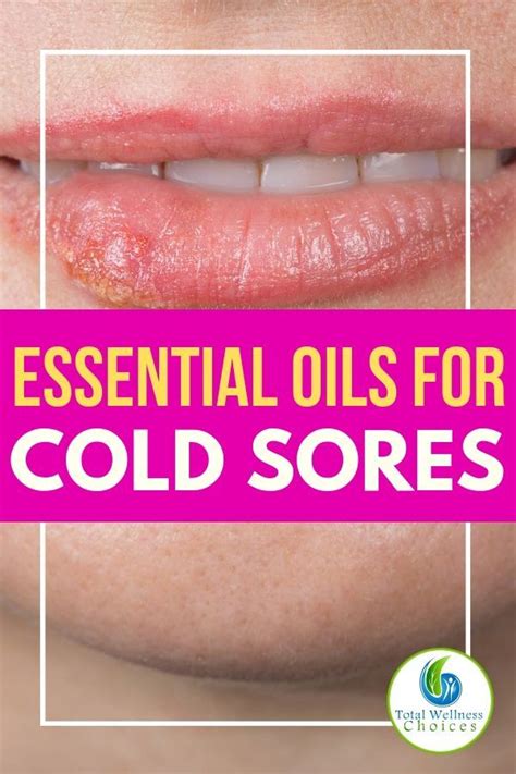 Top 5 Essential Oils For Fever Blisters Cold Sores Essential Oil