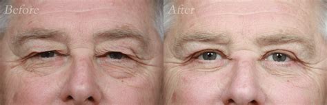 Eyelid Surgery In Silverdale Cole Aesthetic Center