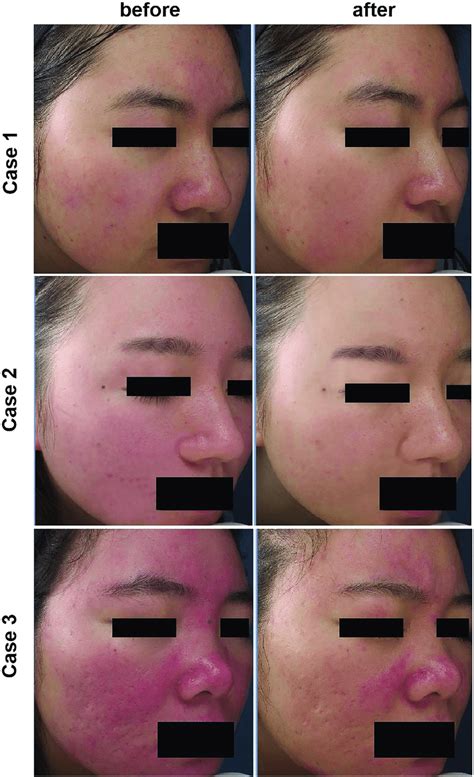 Pictures Of Three Rosacea Patients Before And After Ipl Treatment Download Scientific Diagram
