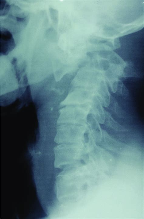 X Ray Of The Cervical Spine Showing Hangmans Fracture With Significant
