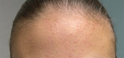Clogged Pores On Face Treatment Acne Symptoms