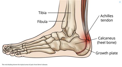 10 Causes Of Heel Pain And When To See A Doctor Raleigh Orthopaedic