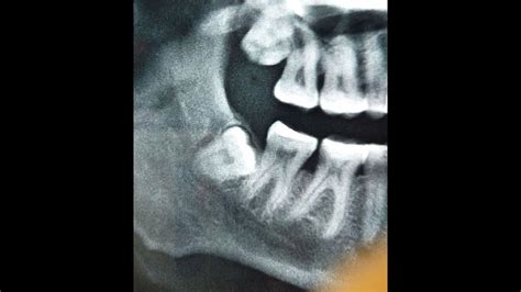 Impacted Molar Surgery Mandibular Third Molar Youtube