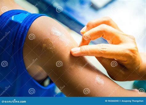 Woman Hand To Treat The Patient`s Arm With Ointment Mosquito Bites