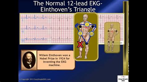 The Normal 12 Lead Ekg And Einthovens Triangle Youtube