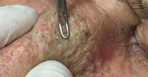 Watch The Disgusting Moment A Man Has Both His Pimples And Blackheads
