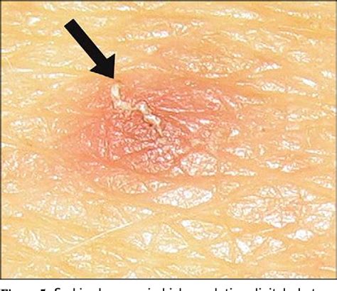 Pdf Scabies A Review Of Diagnosis And Management Based On Mite
