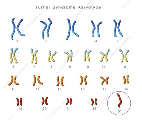 turner s syndrome karyotype illustration stock image c055 5470 science photo library