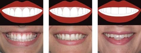 Different Smile Lines According To Tjan Et Al23a High Open I