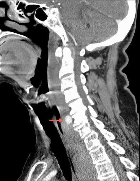 Intramural Oesophageal Haematoma Following Traumatic Neck Injury Bmj