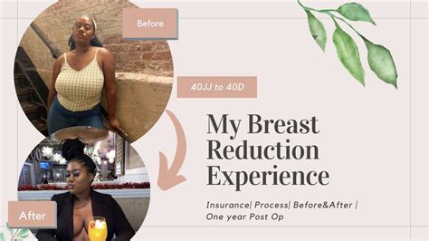 My Breast Reduction Experience Insurance Process Beforeandafter Youtube