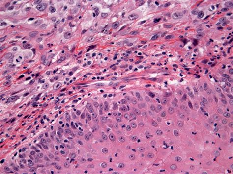 Basal Cell Carcinoma H And E Stain Hanss Histology