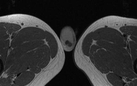 Testicular Epidermoid Cyst Imaging Findings Eurorad