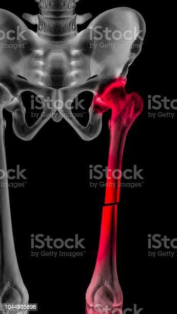 Xray Of Broken Upper Leg Or Femur Fracture Anterior View Completed