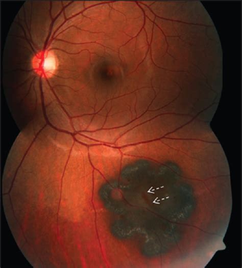 An Unusual Case Of Congenital Hypertrophy Of Retinal Pigment Epithelium