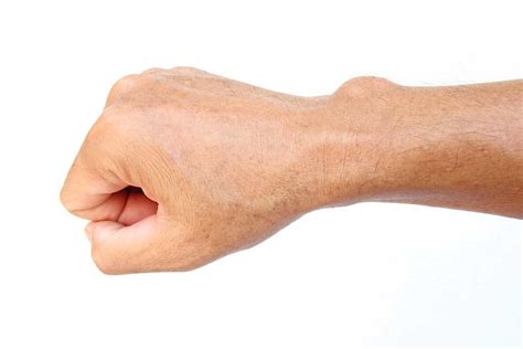 What Is A Ganglion Cyst Orlando Hand Surgery