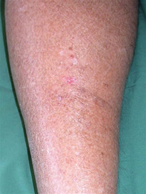 Pictures Of Melanoma Skin Cancer On Legs The Meta Pictures