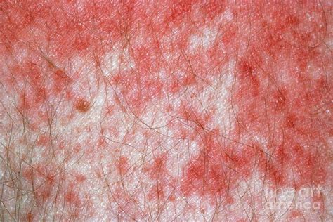 Scabies Rash On Hand Of Aids Patient Photograph By Science Photo Library