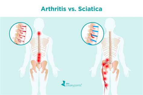 Arthritis Vs Sciatica Differences In Risk Factors Symptoms Treatments