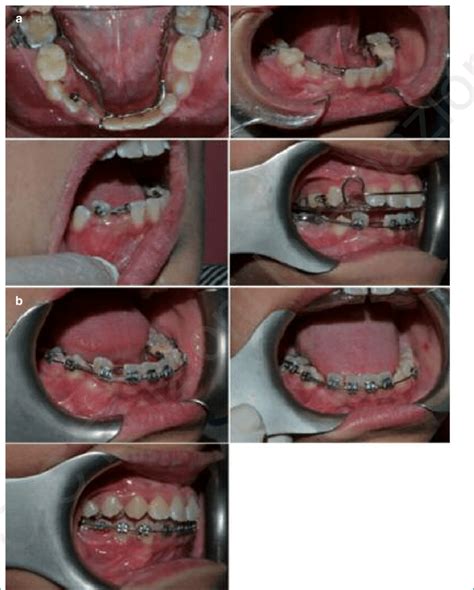 A Pictures Of The Different Phases Of The Orthodontic Treatment B Download Scientific