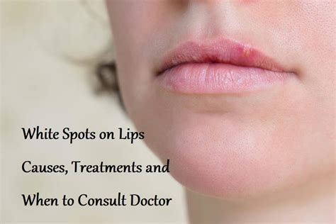 White Spots On Lips Causes Treatments And When To Consult Doctor